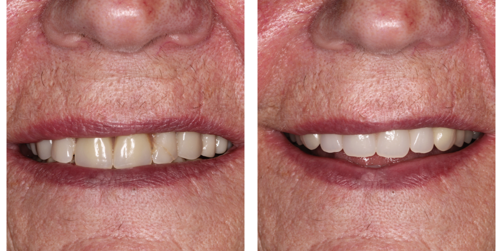 New Denstures Case 1