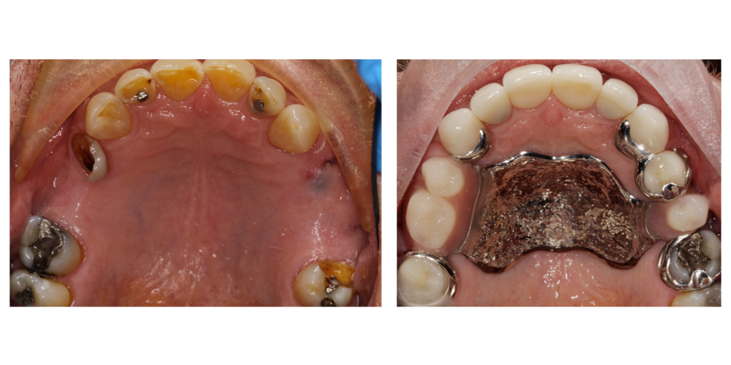 New Denstures Case 2