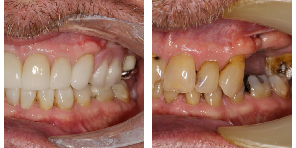 new denstures case 3