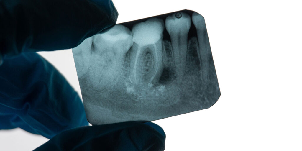 Root Canal xray