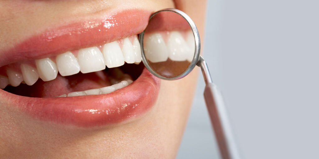 Smile Brighter with White Fillings