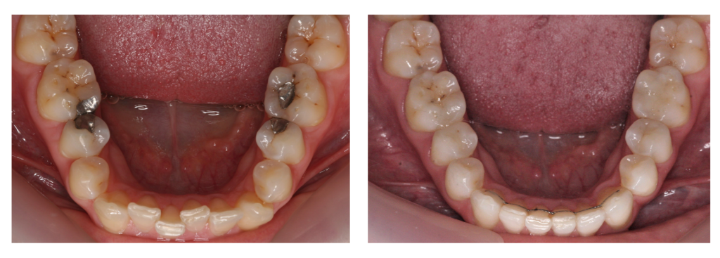 before and after white fillings