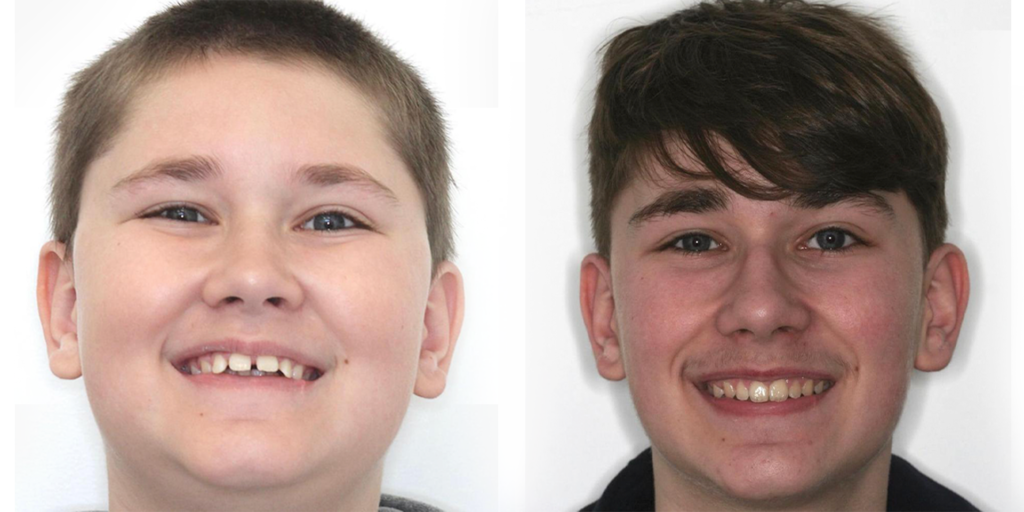 Invisalign gallery invisalign 7