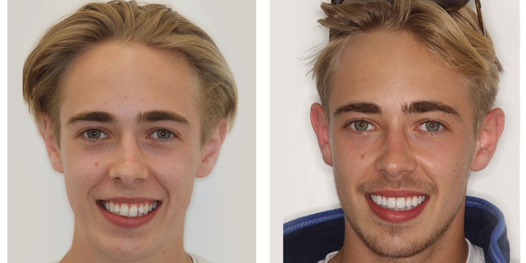 10-ortho-b-a Orthodontic Treatment BA