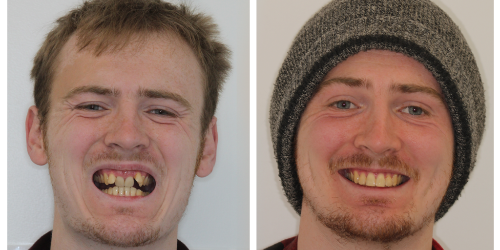 11-ortho-b-a Orthodontic Treatment