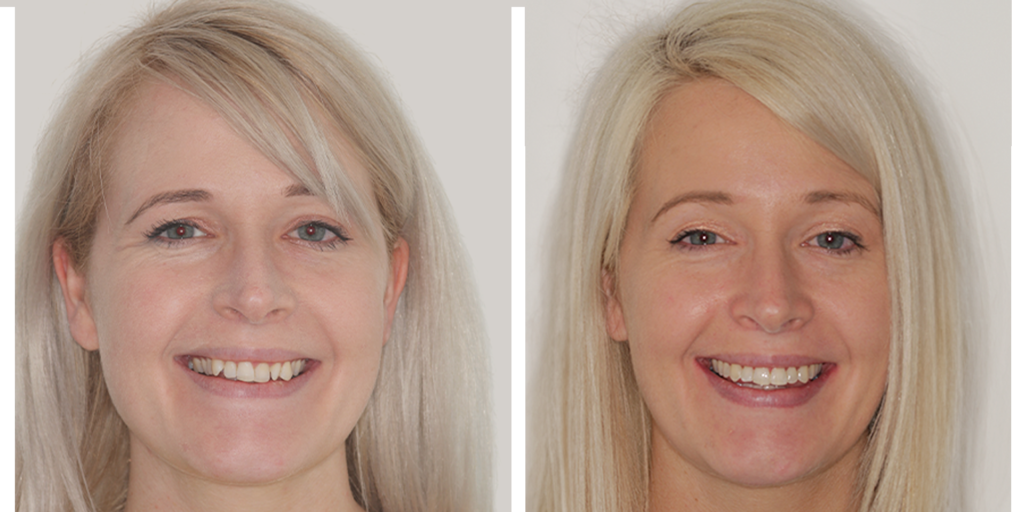 12-ortho-b-a BA ortho