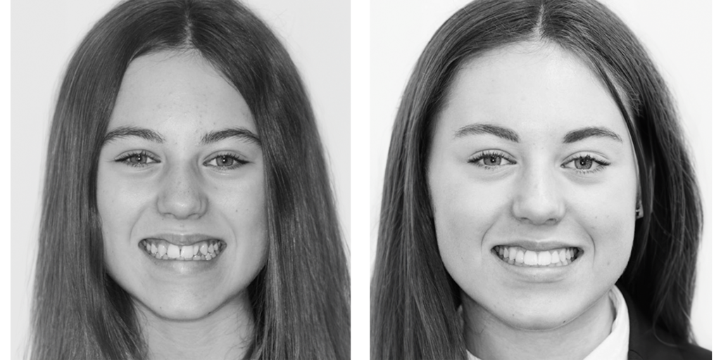 3-ortho-b-a ortho Before & After client