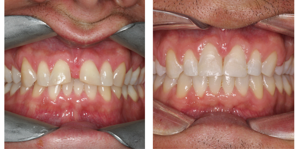 8-ortho-b-a Orthodontic Before After