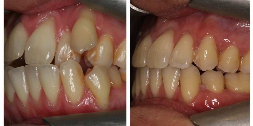 9-ortho-b-a Orthodontic Treatment Before After