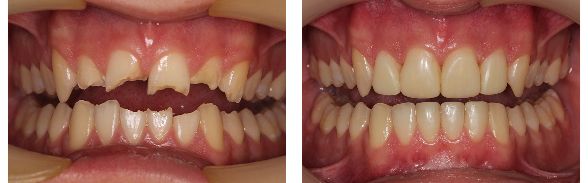 Composite Bonding Dentist Kent Composite Bonding Treatment