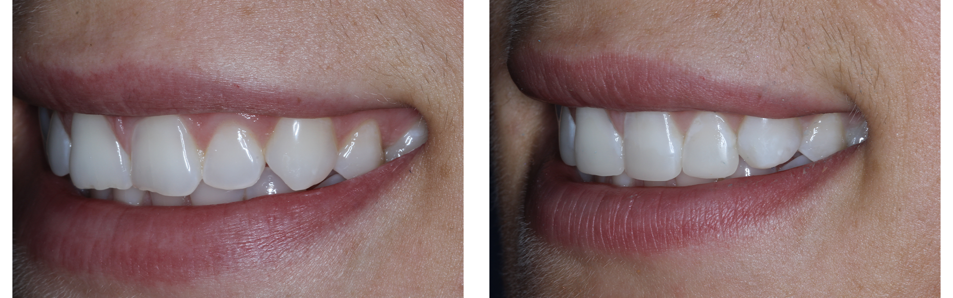 Composite Bonding Dentist Kent Composite Bonding Treatment