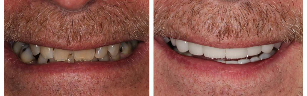 smile-makeovers-1 Smile design