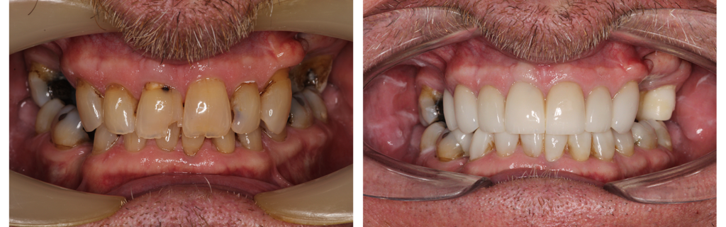 smile-makeovers-2 Before & After smile makeovers