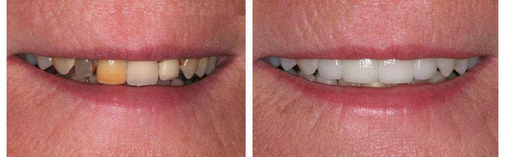 smile-makeovers-3 Cosmetic Smile Makeovers