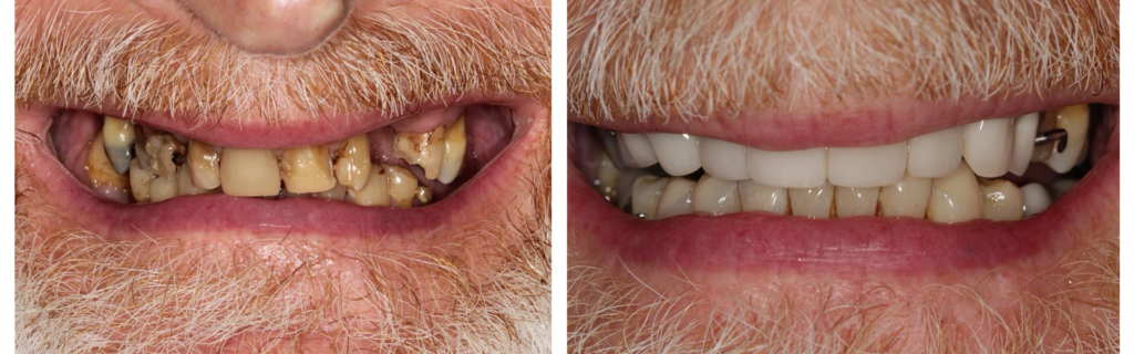 smile-makeovers-4 Smile Makeover - Whitening, Crowns, Bonding and Denture