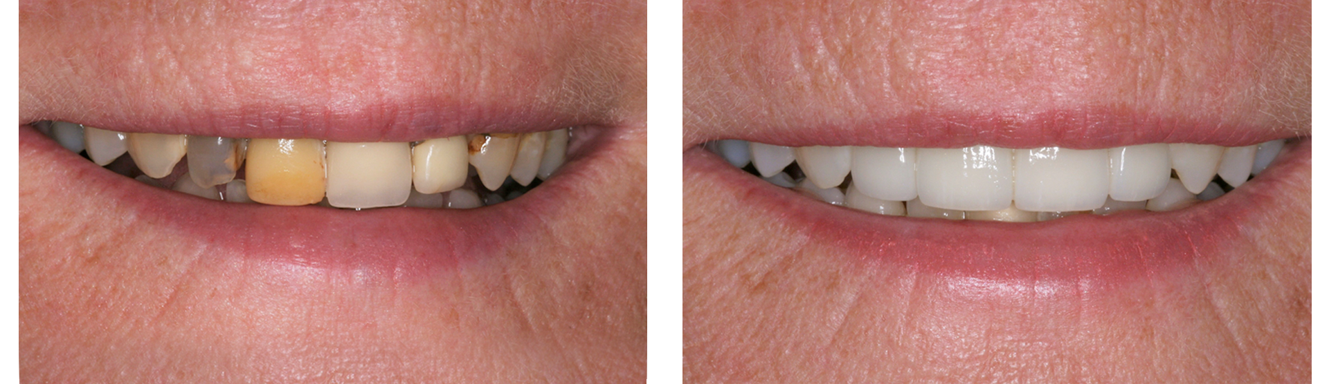 Dental Veneers Pennypot Dental Kent