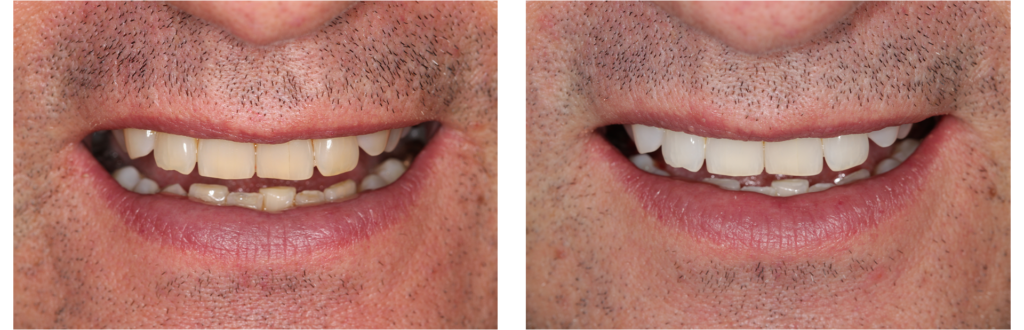 whitening-case-1 whitening case