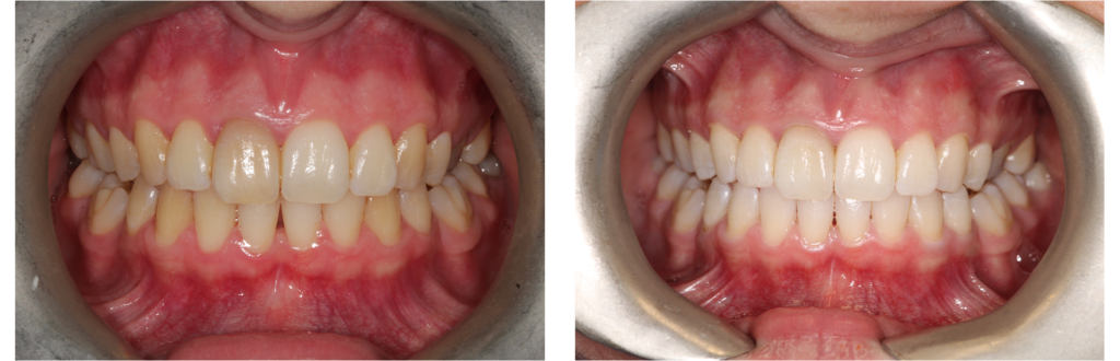 whitening-case-2 whitening case