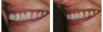 invisalign-1