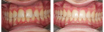 Invisalign
