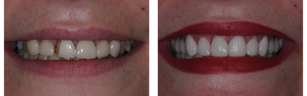 smile-makeover-1 Smile Makeover